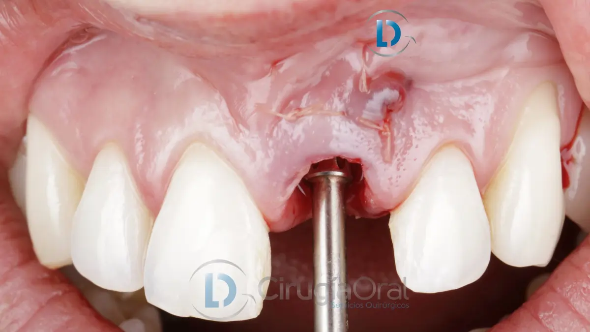 provisional-implant