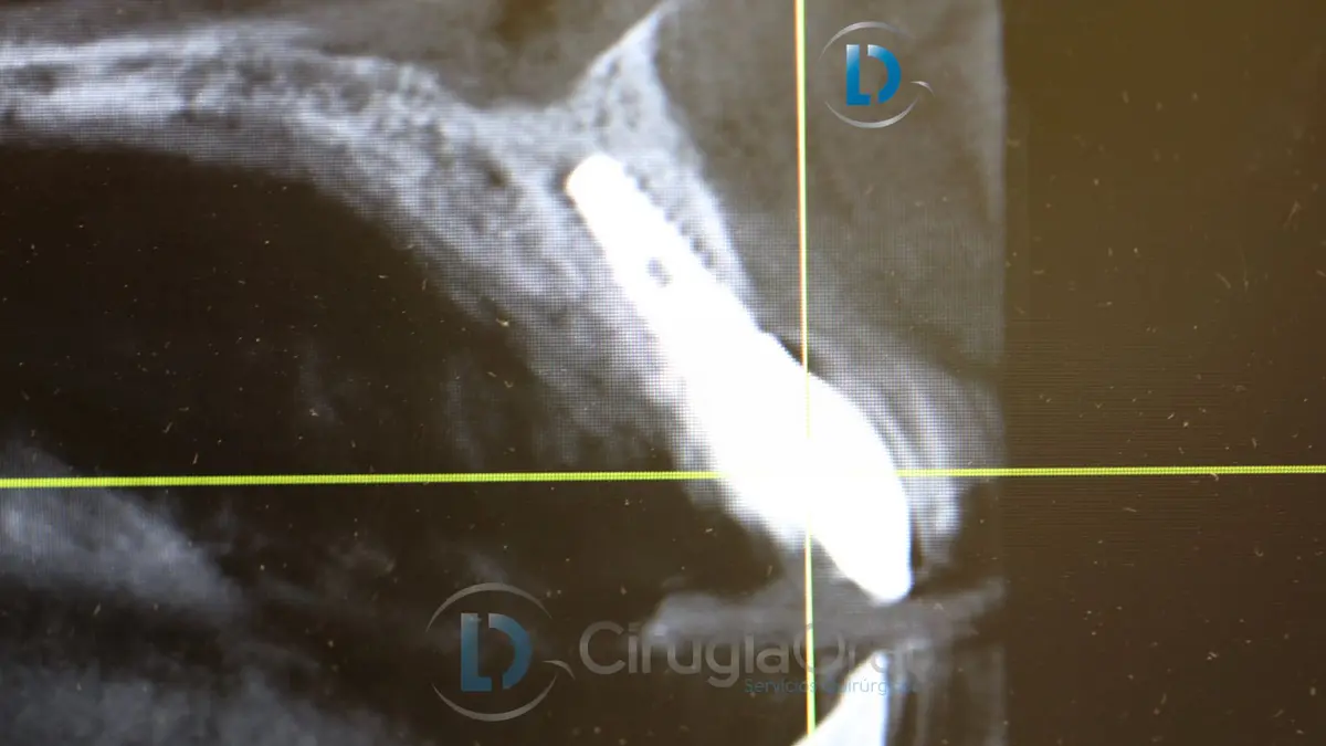 radiographic-inmediate-implant